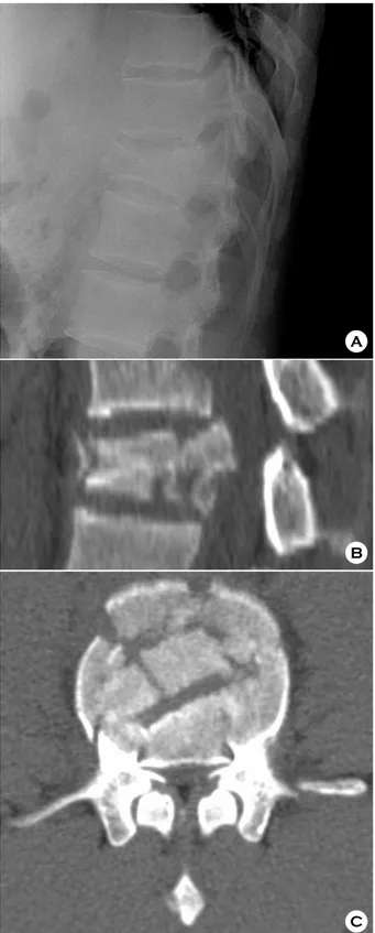 Fig. 2. Vertebral involvement and apposition of fracture fra-  gments. 