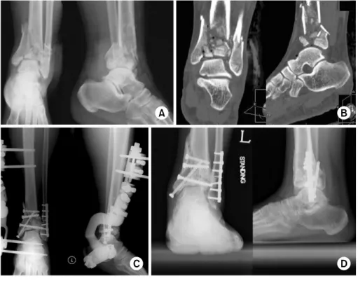 Fig. 1. (A) This 43 year-old male  had a fall injury and sustained a  Ruedi-Allgower type III open  pilon fracture