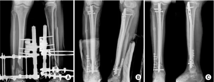 Fig. 1. (A) The preoperative radiograph of a 71-year-old male, who had a type II open distal tibiofibular fracture three month ago, shows external fixator applied state