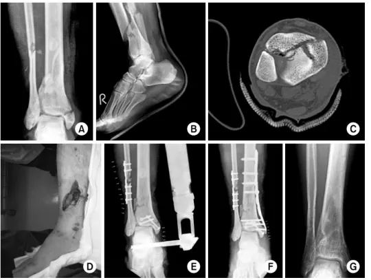 Fig. 2. The 57-year-old male  had a traffic accident, and  sustained a Rüedi-Allgöwer type III fracture (A～C)  and  Gustilo-Anderson type IIIA  open pilon fracture of right  ankle  (D)