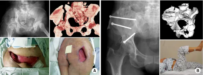 Fig. 3. (A) A 59 year-old woman sustained both column open pelvic bone fracture.
