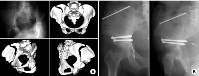 Fig. 4. (A) A 47 year-old women complained of right hip pain and limping. Preoperative X-ray and CT scan show acetabular  nonunion.