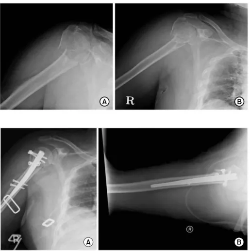 Fig. 1. The preoperative antero- antero-posterior  (A),  axillary lateral (B)  radiograph of 69-year old female  after slip down injury