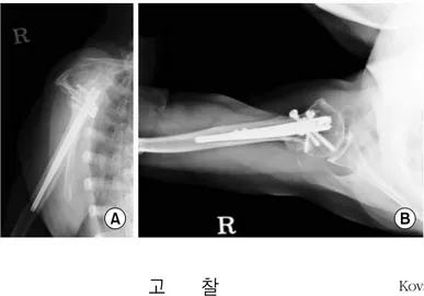 Fig. 5. Radiographs, anteroposterior (A) and axillary  lateral  (B)  taken at 2 years after operation show good  bone union
