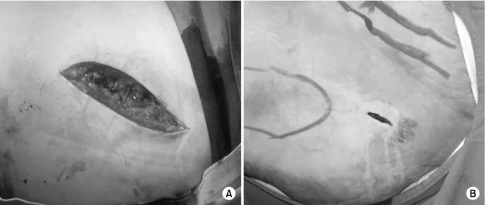 Fig. 2.  (A) Standard incision. (B) Mini-incision. 방사선  투시기를  보면서  환측  다리를  외전  및  외회전한  다음  견인하면서  내외전시킨  후  내전  위치로  골절  침대를  고 정하였다