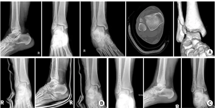 Fig. 4. (A) Initial radiographs &amp; CT of a 62-year- old woman show anterior tibio-fibular ligament avulsion fracture in lateral mal- mal-leolar fracture.