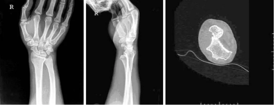 Fig. 2. This picture shows reduced ECU interposed bet- bet-ween the dislocated distal radio-ulnar joint.