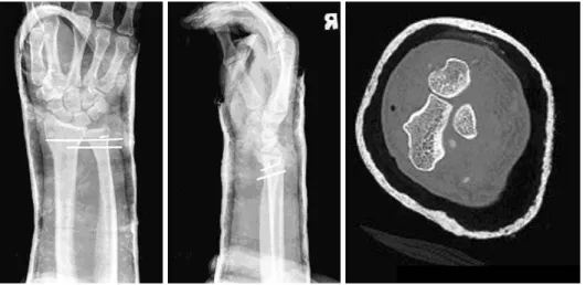 Fig. 3. Postoperative simple  X-ray and CT show  re-duced ulnar head.