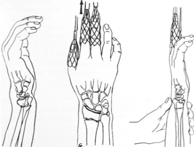 Fig. 5. Chinese finger trap can be used to ease the reduc- reduc-tion. During the steady traction the distal fragment is pushed  to the opposite direction from the initial displaced site.
