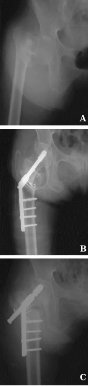 Fig 3-A. Preoperative roentgenogram of 65 years old female, Evans classification ( comminuted ) and Singh index