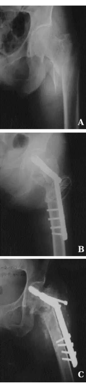 Fig 4-A. Preoperative roentgenogram of 67 years old female, Evans classification ( displaced not reduced ) and Singh index Ⅲ