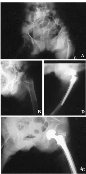 Fig. 2-A : Preoperative both hip anteroposterior radiography of 86 year-old female patient shows type Ⅲ intertrochanteric fracture according to Kyle modification of the classification of Boyd-Anderson.