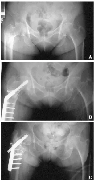 Fig. 2 : Serial radiograph of 74 year old woman treated by a compression hip screw. A