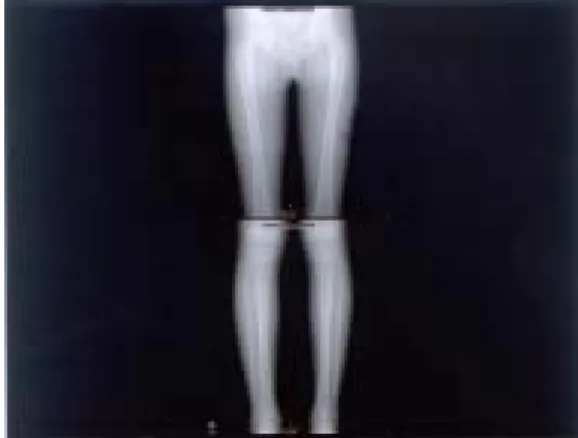 Fig. 5. A valgus mold was placed at the fracture site and  meticulous molding on popliteal fossa 