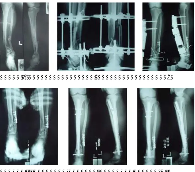 Fig. 2A.  A 61-year-old man was injured by traffic accident, and he had left distal tibial intraarticular comminuted open fracture and fibular segmented fracture