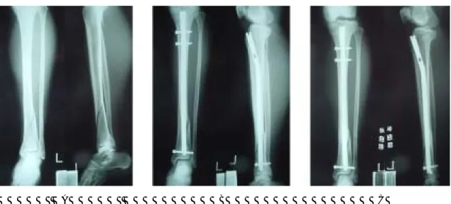 Fig. 3A.  36-year-old woman was injured by slip down, and she had distal tibial and proximal fibular fractures