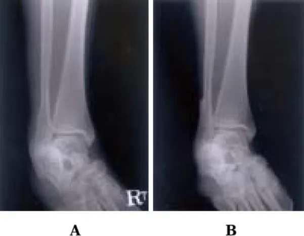 Fig. 3. Mortise radiographs of the right ankle. 29 years old, female. 