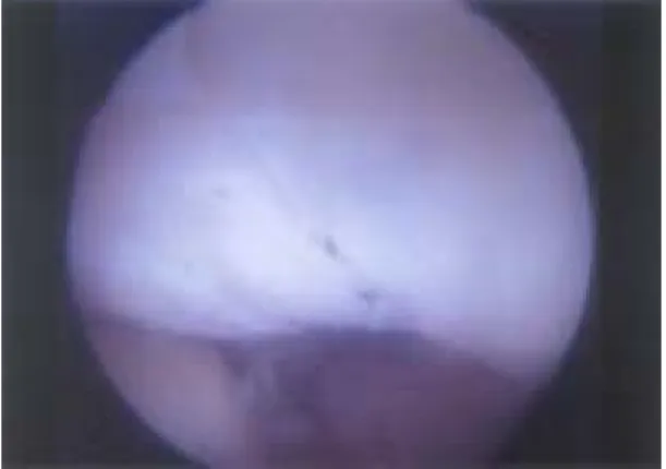 Fig. 2. Radiograph showing internal fixation using K-wires and cerclage wiring. 