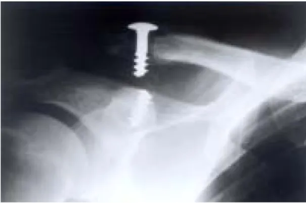 Fig. 3. After postoperation 2 months, Radiograph demon- demon-strating breakage of screw