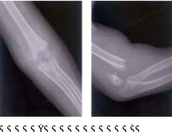 Fig. 2. Post-operative X-ray of Gartland type III completely displaced supracondylar fracture of humerus (2A