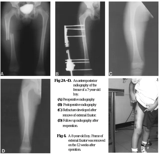 Fig 4.   A 8-year-old boy. Frame of external fixator was removed on the 12 weeks after operation