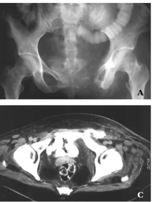 Fig 3-C.  Pelvic bone computerized tomography shows extravasation of contrast to the extraperitoneal s p a c e .