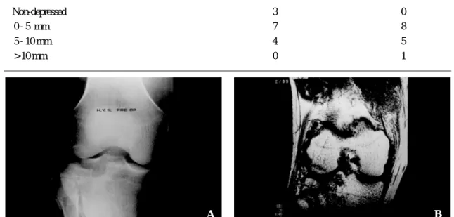 Fig. 1.   Reclassification of Schatzker-type I to II after MRI evaluation. 