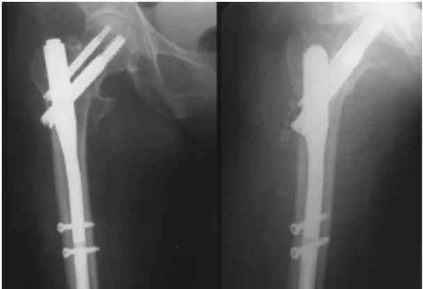 Fig 2-A : A 80-year-old woman with AO-Muller type A2.1 and Evans-Jensen type IV