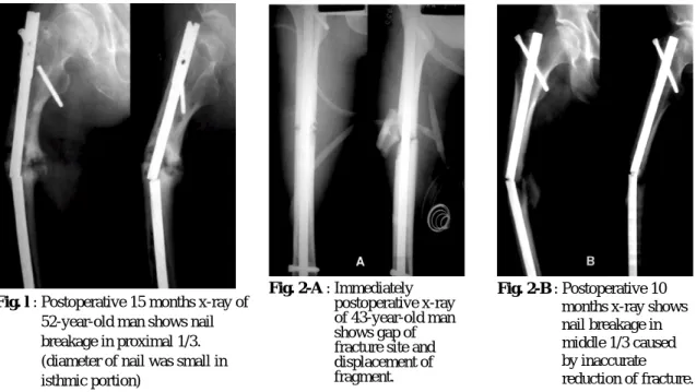 Fig. l : Postoperative 15 months x-ray of 52-year-old man shows nail breakage in proximal 1/3.