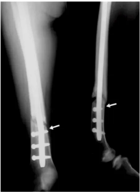 Fig. 4 : Postoperative x-ray shows that distal first locking screw was inserted not perpendicular to nail          