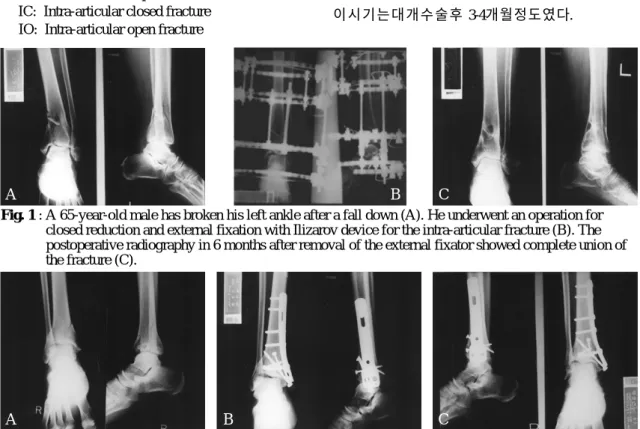 Fig. 2 : A 47-year-old male has broken his right ankle after a fall from a height (A)