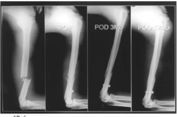 Fig. 1 : Radiographs of the humeral shaft fracture of 23 year old male patient treated with DCP.