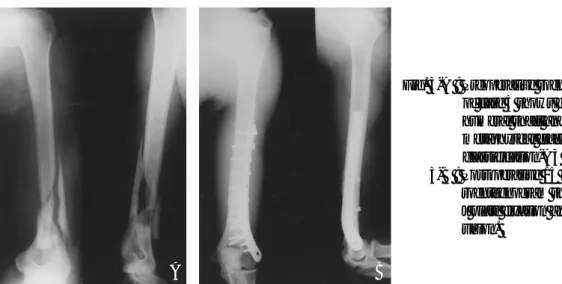 Fig. 3-A : Preoperative roentgenogram of case 5 shows distal humeral shaft and metaphyseal fracture (AO classification-A3 type)