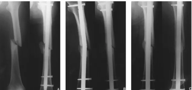 Fig. 1-A : The preoperative  roentgenogram of  58-year-old man  shows Winguist-Hansen type II femoral shaft fracture (Lt), and the  postoperative roentgenogram shows medial fracture gap with displaced fracture fragment(Rt).