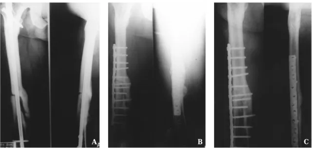 Fig. 3-B : The postoperative radiograph  after osteosynthesis with  compression plate and bone grafting shows obliteration of fracture gap.