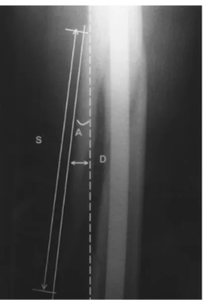 Fig. 1 : The methods of measurement of the size(S), distance(D) and angulation(A) of
