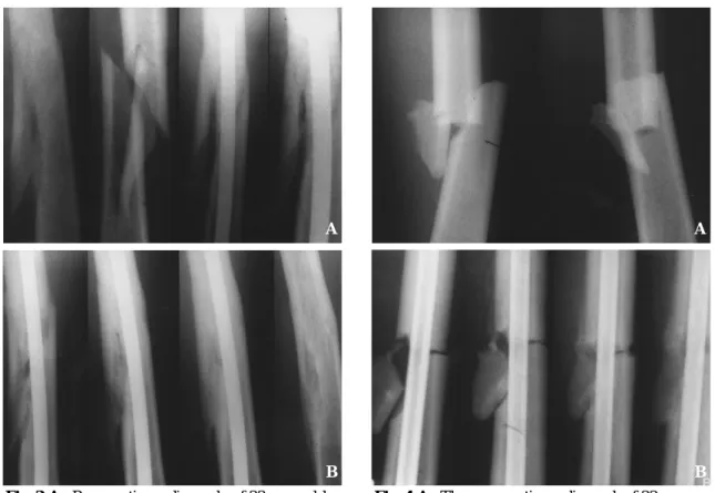 Fig. 3-B : The 3 months, 6 months and 12 months follow up radiograph  shows gradual decrease  in angulation of fragment and at 5 year follow up, the nail is removed.