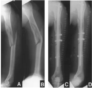 Fig. 3-A, B : 50-years-old man with comminuted fracture of the left humeral shaft. 