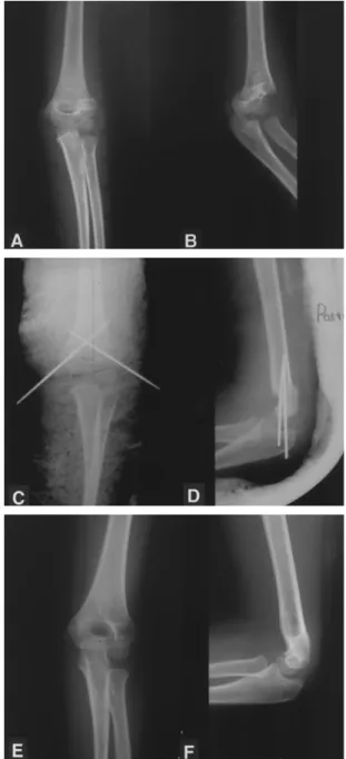 Fig. 2-A : At first,  the medial percutaneous pinning was done and, B : the next lateral pin was inserted.