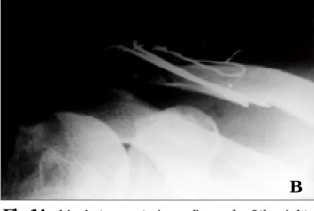 Fig 1B.  Immediate postoperative radiograph : Open reduction &amp; Interfragment K-wire and wire fixation
