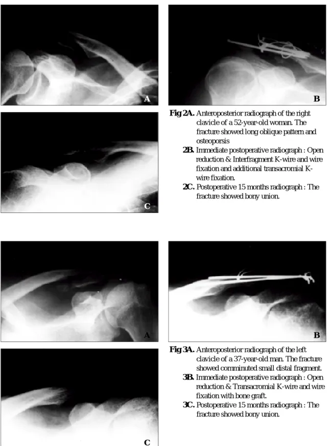 Fig 2B.  Immediate postoperative radiograph : Open reduction &amp; Interfragment K-wire and wire fixation and additional transacromial  K-wire fixation.