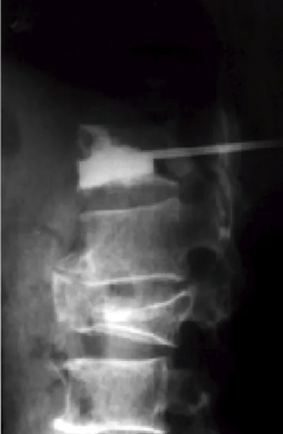 Fig 2.  Injection of contrast material in the lateral plane shows filling of the bony trabeculae.