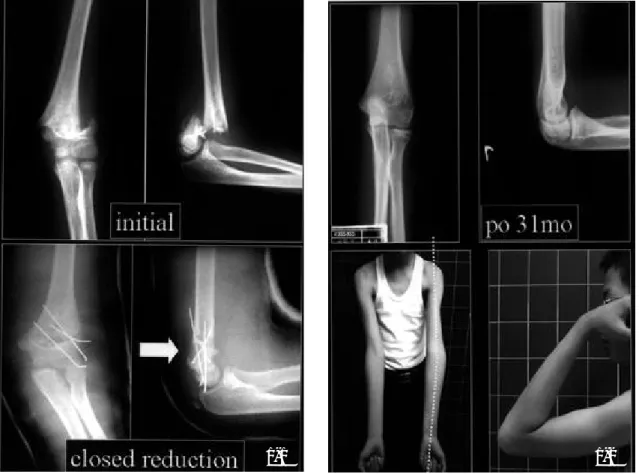 Fig 1.  10 year-old boy had a grade III supracondylar fracture of the left humerus