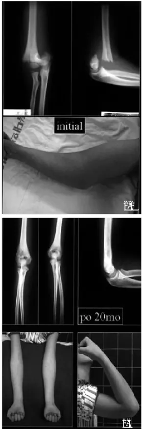 Fig 2-1.  The initial film showed the postero-medial displacement(upper). The elbow was so swollen that closed reduction was failed.