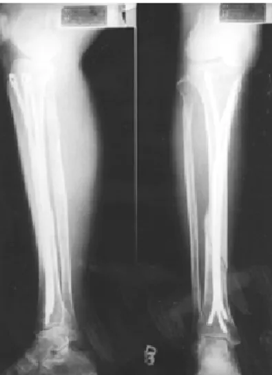Fig 1. Radiographs of right tibia of 55-year-old woman show bridging callus with good alignment