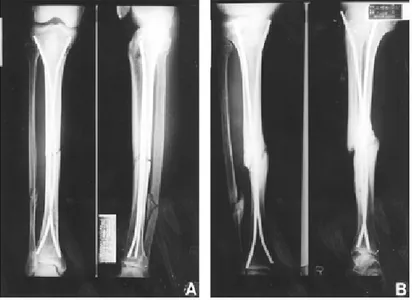 Fig 3. Follow up radiographs of 20-year-old man with segmental comminuted fracture of left tibia show 11 degrees of posterior