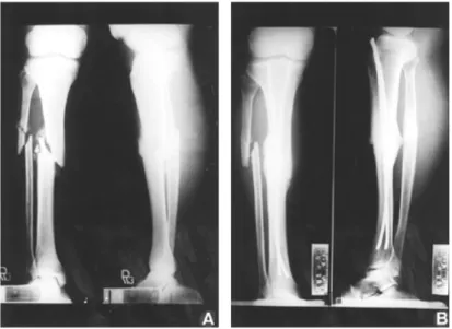 Fig 4. Radiographs of 57-year-old man with fractures in middle third of left tibia and fibula
