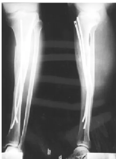 Fig 5. Healed segmental comminuted fractures in distal third of left tibia and fibula show 15 degrees of posterior angulation and 11 degrees of valgus angulation
