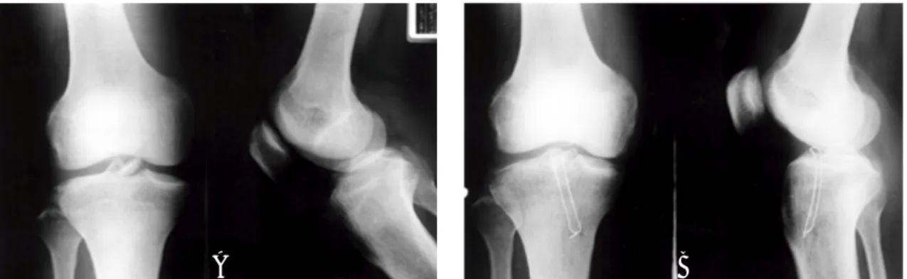 Fig 1A. Type III tibial intercondylar eminence fracture Preoperatve X-rays. 