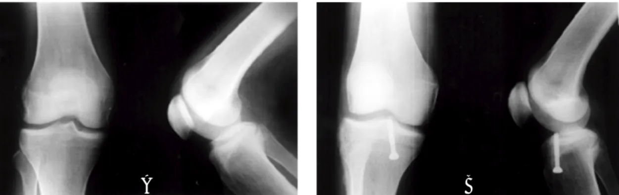 Fig 2A. Type II tibial intercondylar eminence fracture combined with lateral meniscal injuries.